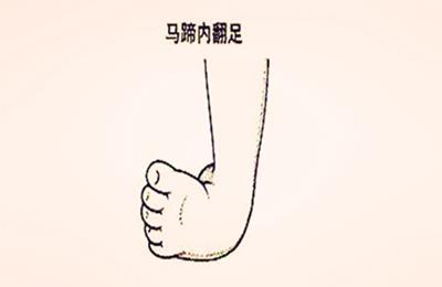 马蹄足与足内翻的3点区别!