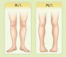 内八字脚有什么危害内八字脚如何矫正