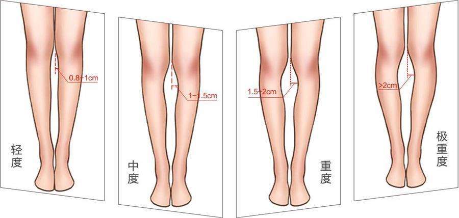 o型腿可以矫正过来吗?