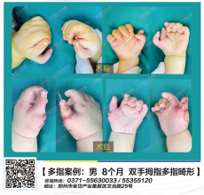 多指畸形的最佳手术时间是什么时候？郑州哪家医院做多指切除效果好？