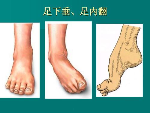 足内翻