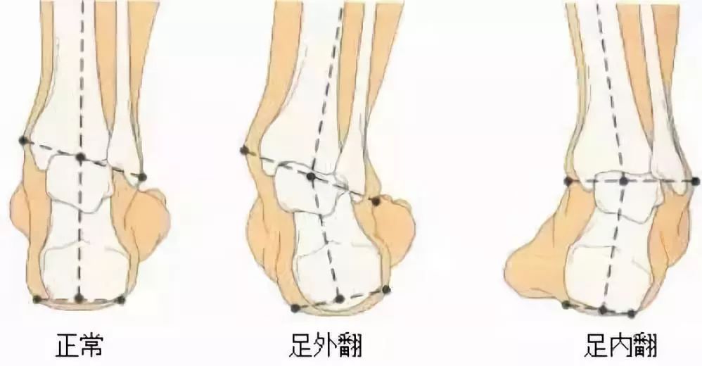 马蹄足