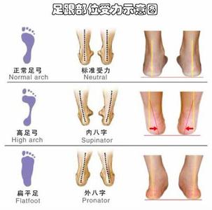 高弓足是怎么引起的?