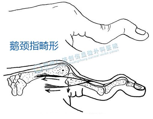 鹅颈指什么时候做手术合适