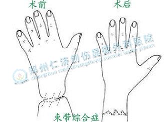 在线解答:羊膜束带综合症的原因
