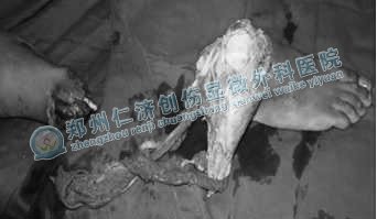 右小腿远端踝部已经完全离断