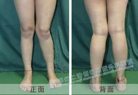 x型腿女孩儿在仁济成功看好,邂逅美爱情