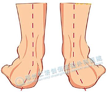 足外翻非同小可 切莫忽视治疗