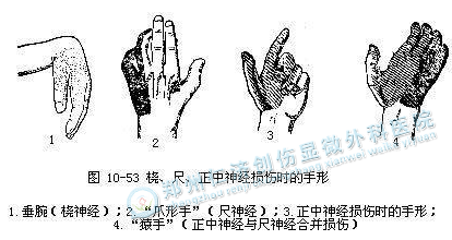 了解这些症状 轻松判定尺神经损伤