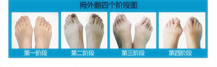 郑州治疗拇外翻多少钱