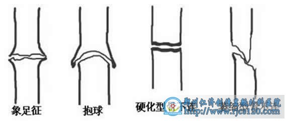 骨不连的病因