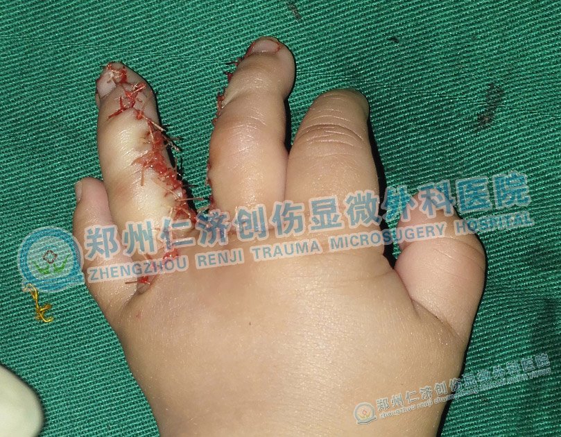 分离"二合一"的手指,显微技术一招攻破!